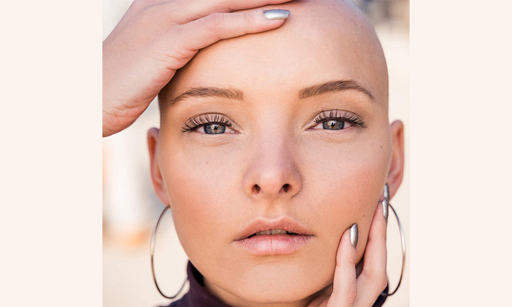 Aus dem Leben eine Alopecianers – Tina