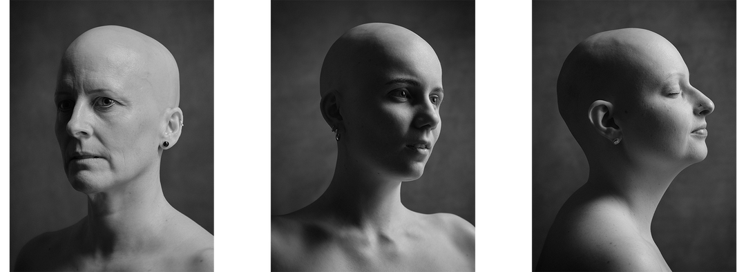 Fotografisches Projekt «finding beauty beyond baldness»
